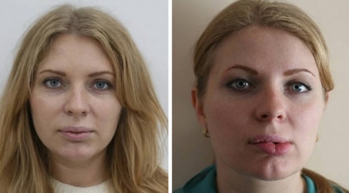 No te podrás creer lo mal que le quedan a estas chicas los labios operados ¡OMG!