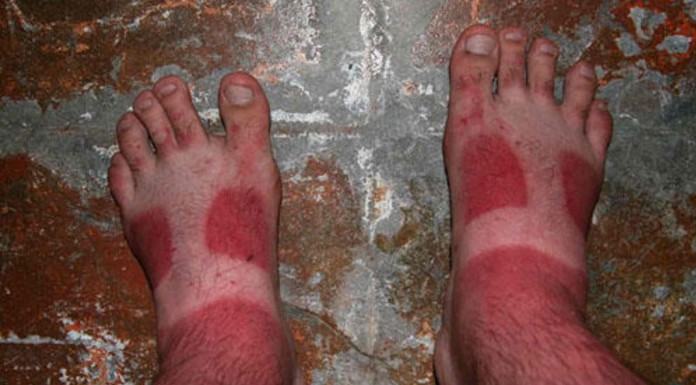 Estas personas estuvieron tanto tiempo al sol que al final quedaron casi achicharrados. No te pierdas estas fotos, ¡son divertidísimas!