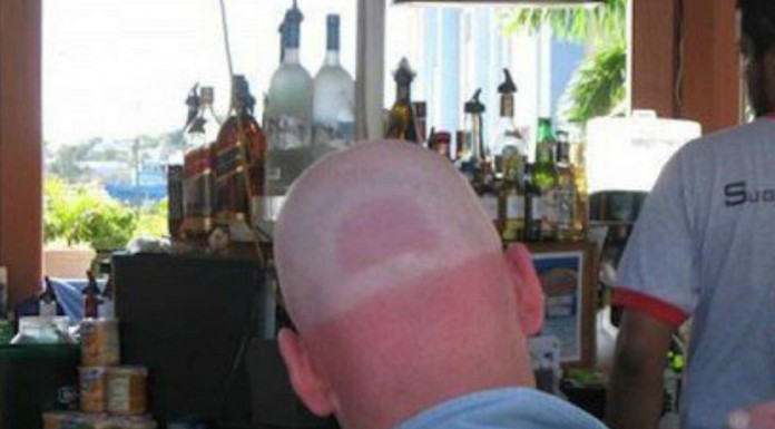 Marcas del sol ¡muy poco favorecedoras! (Parte II)