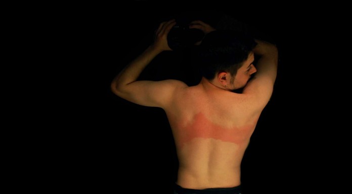 Marcas del sol ¡muy poco favorecedoras! (Parte III)